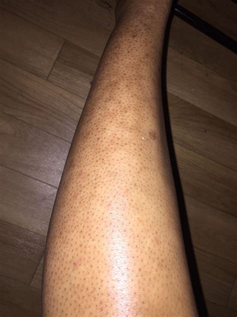 dark spots on legs after shaving